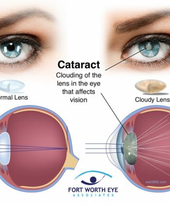 HSI-724 CATARACT NEEDLE